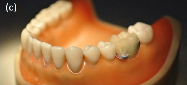 tooth-implant